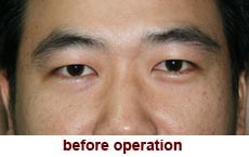 plastic-surgery-blepharoplasty